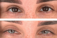 Keratopigmentation-method.png