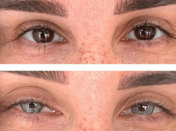  Kératopigmentation : Corriger les imperfections cornéennes et sublimer la beauté des yeux