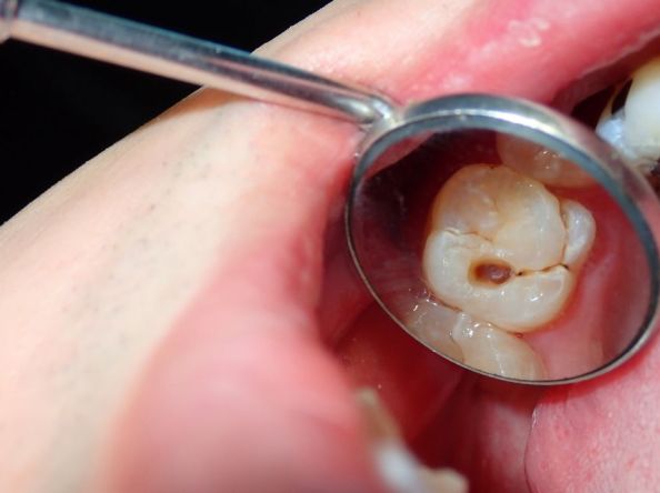 ￼Quand faut-il privilégier un onlay plutôt qu’une couronne dentaire ?